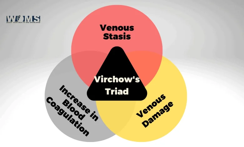 Virchow's Triad