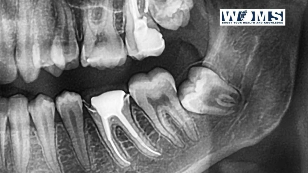 Wisdom teeth real pictures-xrays