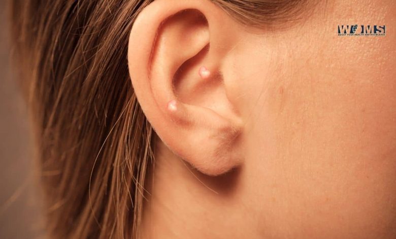 Pimple in Ear