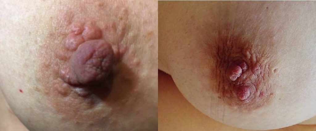 skin tag on nipple