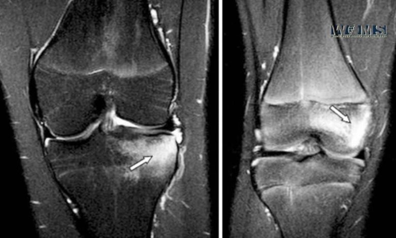 Bone Marrow Edema