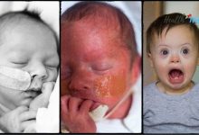 Neonatal Marfan Syndrome