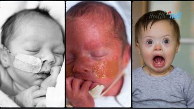 Neonatal Marfan Syndrome