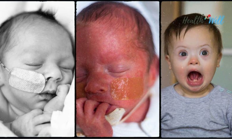 Neonatal Marfan Syndrome